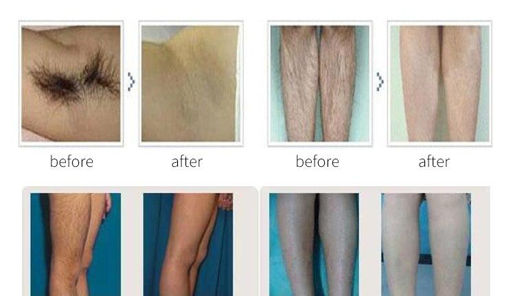 High Quality OPT Hair Removal Beauty Laser Machine Q Switched Nd Yag Laser Hair Removal Multifunction Beauty Machine